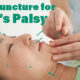 Woman getting facial acupuncture