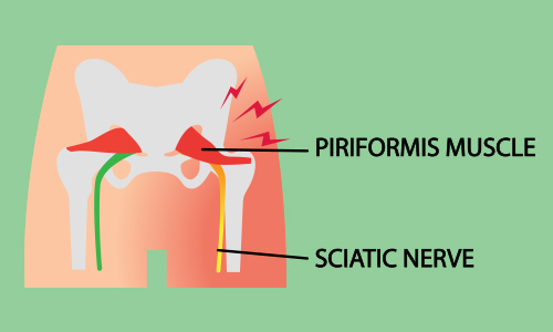illustration of where sciatica pain is located