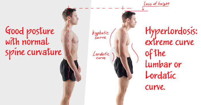 hyperlordosis exercises