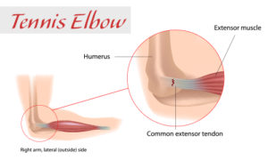 Acupuncture treats tennis elbow
