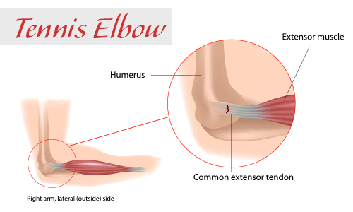 Acupuncture treats tennis elbow