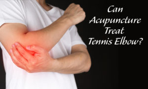 Can Acupuncture Treat Tennis Elbow
