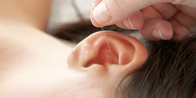 Ear Acupuncture