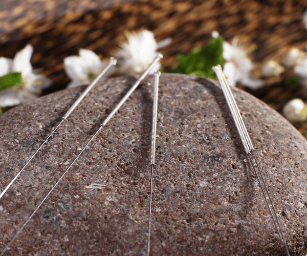 acupuncture treatment